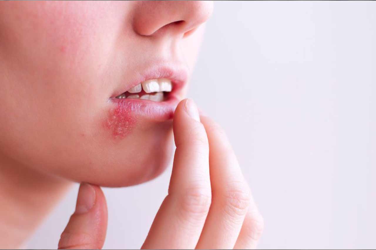 herpes-every-truth-you-need-to-know-about-it-host-and-care-medical