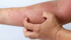 Atopic dermatitis eczema asthma of the skin
