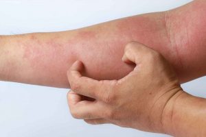 Atopic dermatitis eczema asthma of the skin