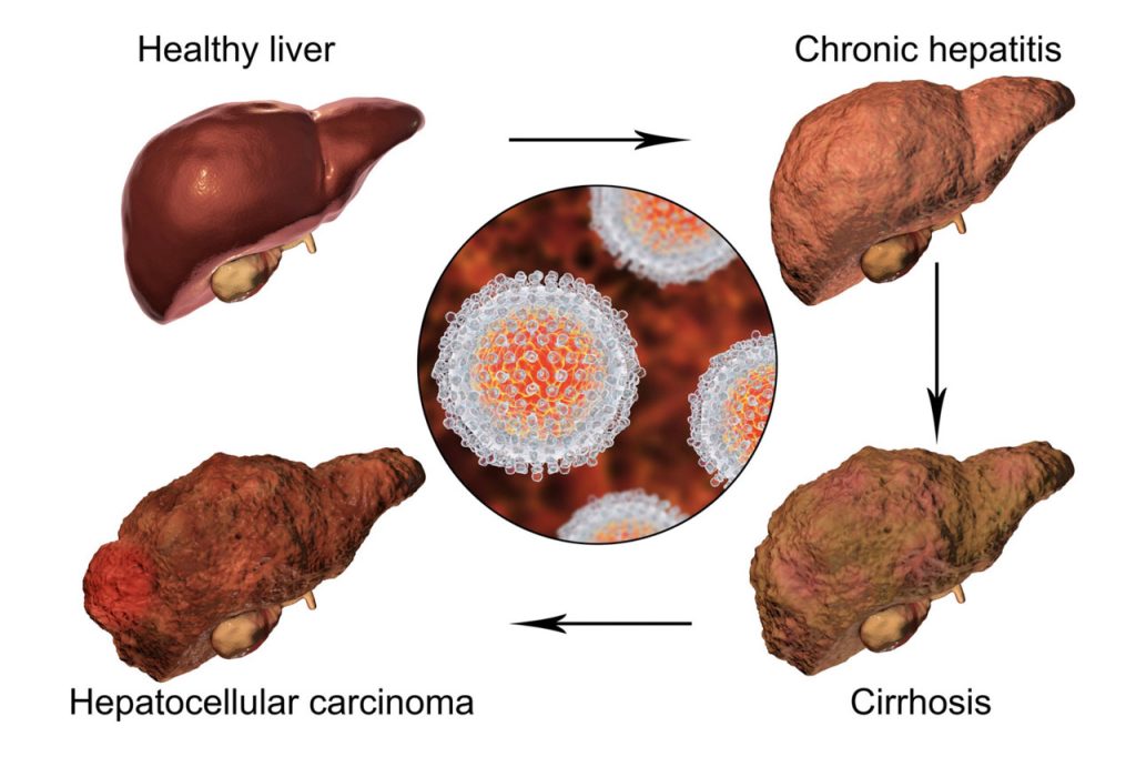 fatty liver