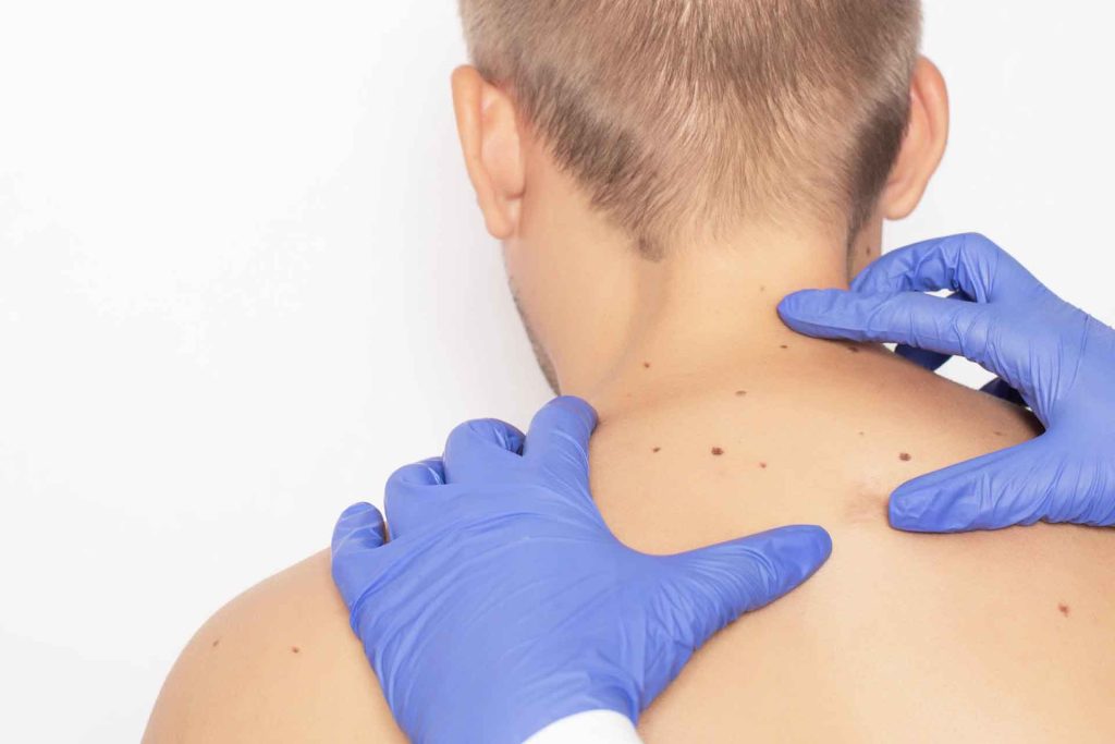 skin cancer do - Host and Care Medical Journal