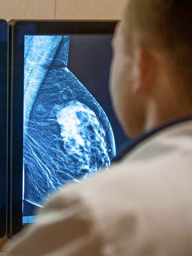 Mammography: Advancements in Breast Cancer Screening