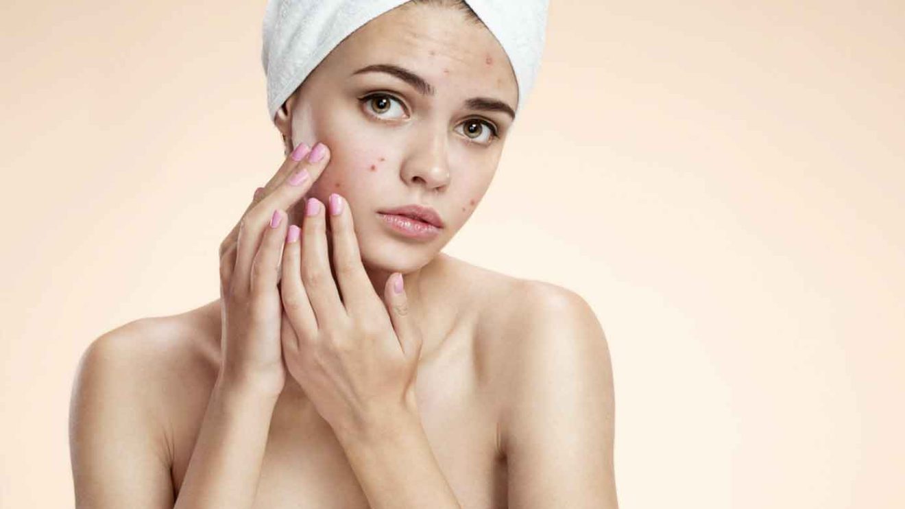 Pimple Acne symptoms and treatment host and care
